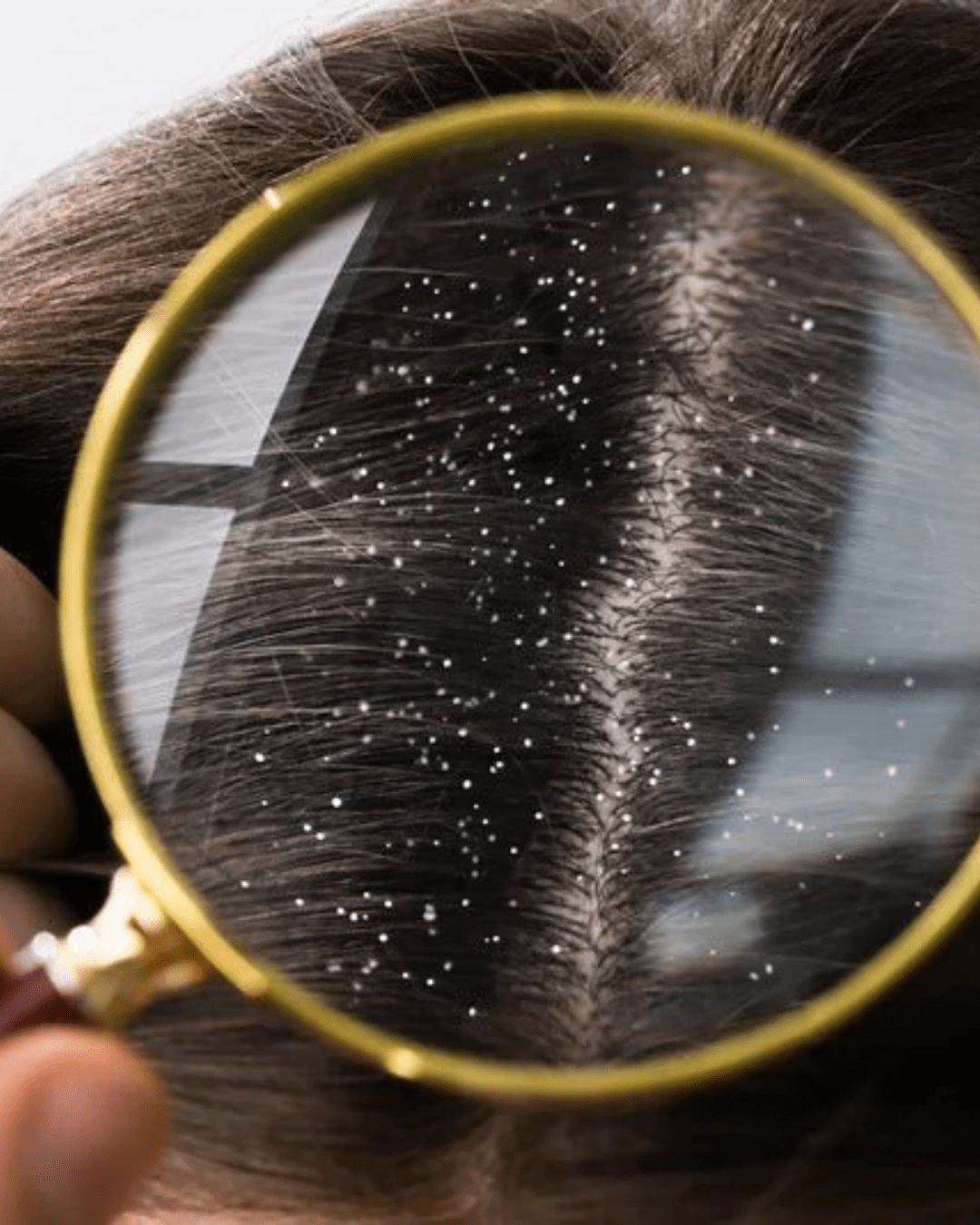 D’où viennent les pellicules et comment s’en débarrasser rapidement ?